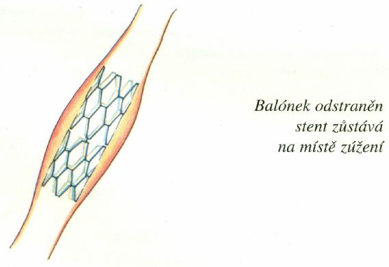 perkutanni-koronarni-transluminalni-angioplastika-ptca-informace-6
