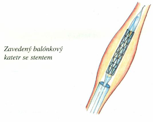 perkutanni-koronarni-transluminalni-angioplastika-ptca-informace-postup-4