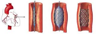 perkutanni-koronarni-transluminalni-angioplastika-ptca-informace
