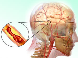 Moderní trombolýza mozková mrtvice zprůchodnění tepny cévy indikace kontraindikace komplikace