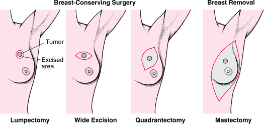 operace-rakoviny-prsu-video-animace-druhy